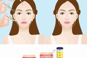 Cấy mỡ mặt giá bao nhiêu, cần lưu ý gì khi thực hiện?