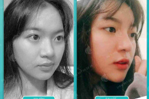  Ai nên nâng mũi cấu trúc? Tại sao?