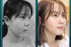 Sụn Megaderm là gì? Có công dụng thế nào trong nâng mũi