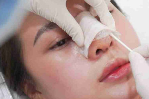 Bác sĩ giải đáp: Vì sao nâng mũi bị đóng vảy?