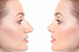 Bác sĩ giải đáp: Nâng mũi có cần mài xương mũi không? 
