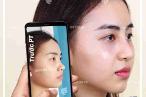Bác sĩ giải đáp: Nâng mũi bao lâu thì được vặn vẹo mũi?