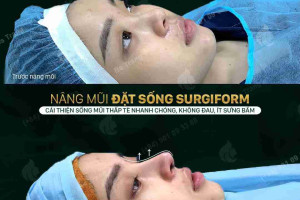 Bác sĩ giải đáp: Nâng mũi bị đỏ đầu mũi có sao không?