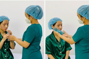 Quá trình phục hồi sau nâng mũi đúng cách