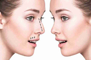 Sửa sóng mũi gồ như thế nào để có dáng mũi đẹp?