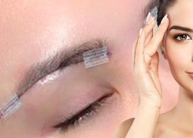 Treo cung chân mày – Giải pháp cho đôi mắt trẻ trung, to tròn