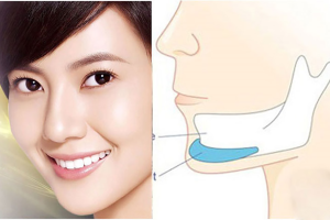 Độn cằm có gây nguy hiểm không?