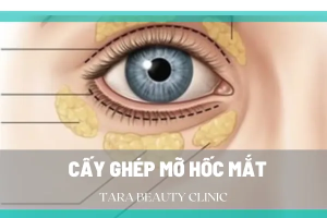 Toàn bộ thông tin về cấy mỡ tự thân hốc mắt trẻ hóa mắt