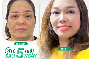Căng da Midface giúp cải thiện những gì trên gương mặt?