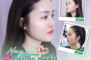 Nâng mũi không nẹp cứng: Lựa chọn số 1 cho người livestream
