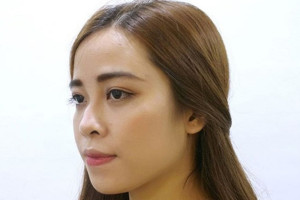 Giải pháp nâng mũi phù hợp cho người mũi gãy