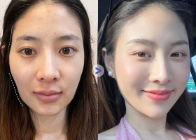 Cấy mỡ mặt có tan theo thời gian không?