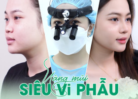 Nâng mũi siêu vi phẫu bằng sụn nhân tạo: Lựa chọn phù hợp cho từng dáng mũi